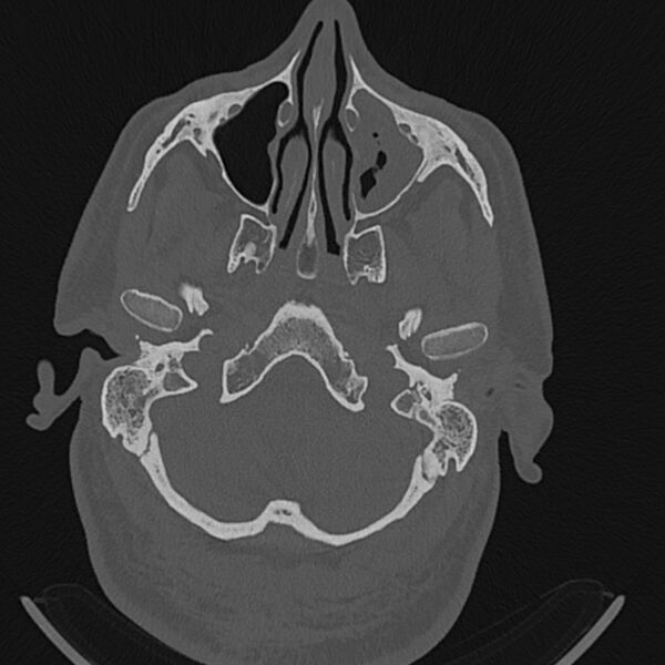 File:Cholesteatoma (Radiopaedia 68176-77673 Axial bone window 7).jpg