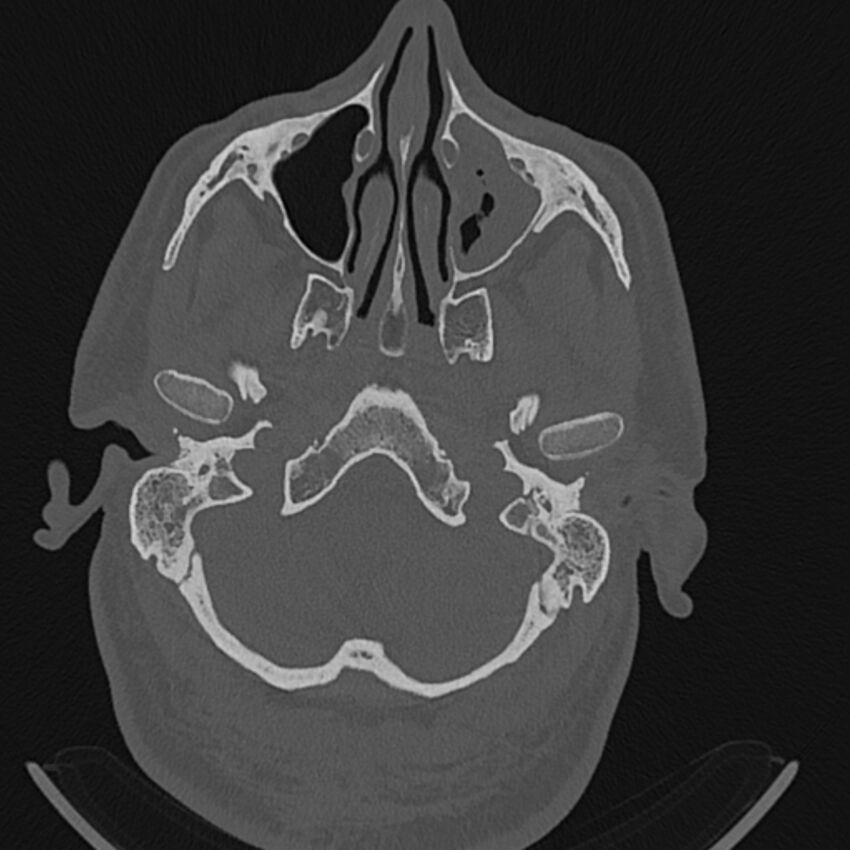 Cholesteatoma (Radiopaedia 68176-77673 Axial bone window 7).jpg