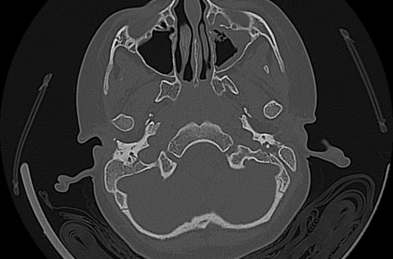 File:Cholesteatoma (Radiopaedia 73023-83750 Axial bone window 5).jpg