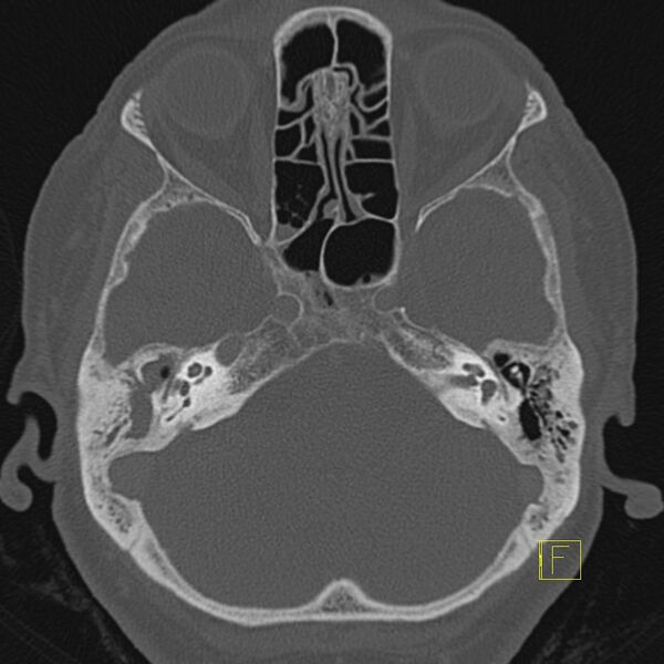 File:Cholesteatomatous chronic otitis (Radiopaedia 14993-14911 Axial bone window 11).JPEG