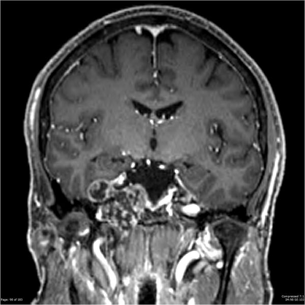 File:Chondrosarcoma of skull base- grade II (Radiopaedia 40948-43654 Coronal T1 C+ 9).jpg