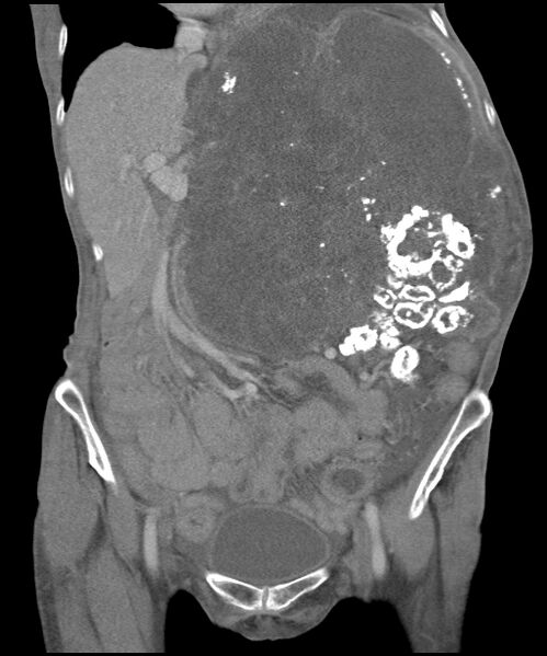 File:Chondrosarcoma of the spine (Radiopaedia 49871-55143 B 24).jpg