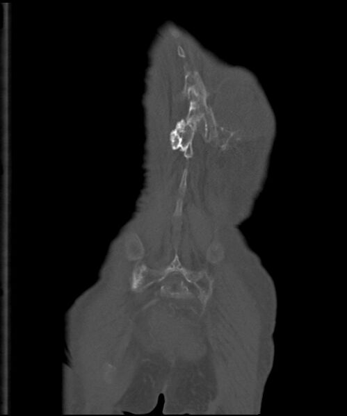 File:Chondrosarcoma of the spine (Radiopaedia 49871-55143 Coronal bone window 3).jpg