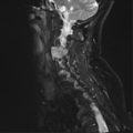 Chordoma (C4 vertebra) (Radiopaedia 47561-52189 Sagittal T2 fat sat 10).png