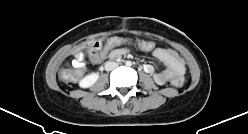 File:Choriocarcinoma liver metastases (Radiopaedia 74768-85766 A 120).jpg