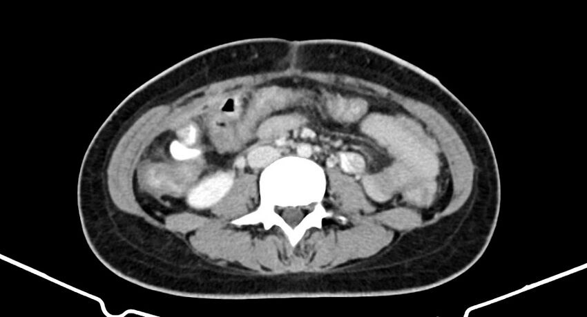 Choriocarcinoma liver metastases (Radiopaedia 74768-85766 A 120).jpg