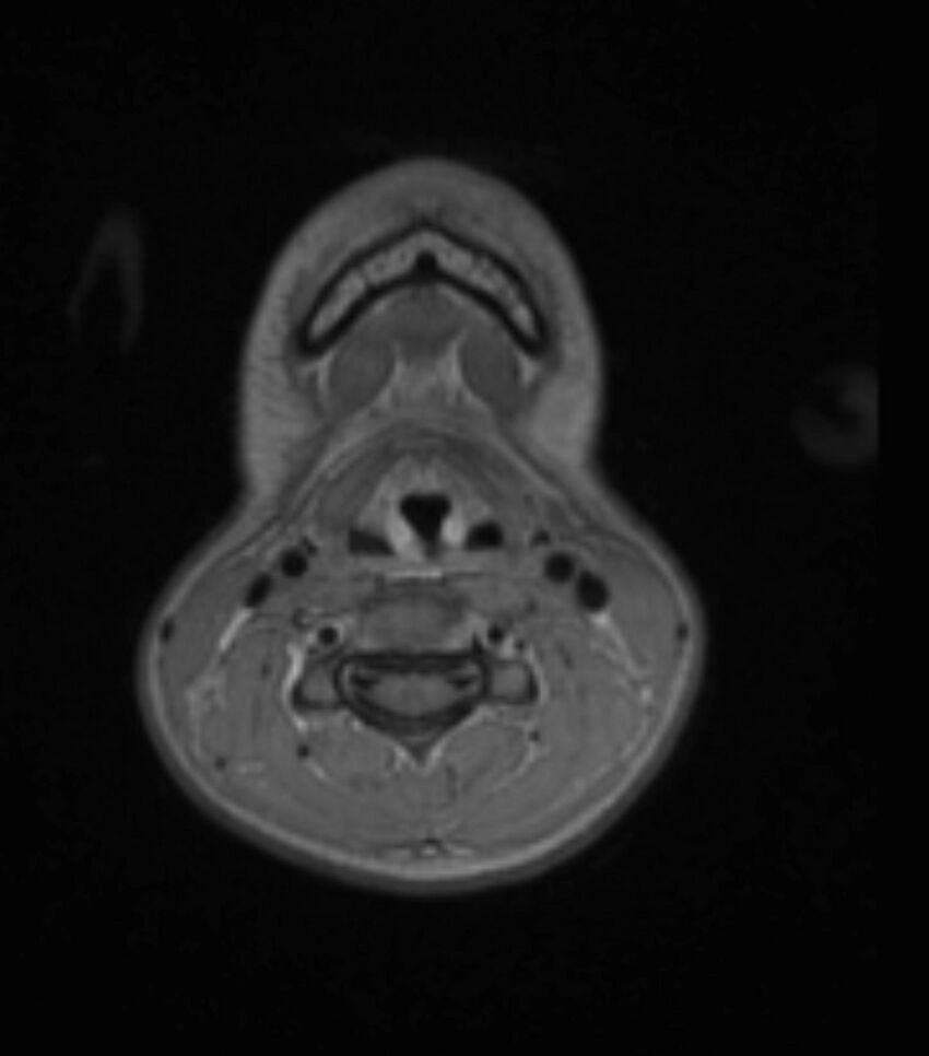 Choroid plexus carcinoma (Radiopaedia 91013-108553 Axial T1 C+ 14).jpg