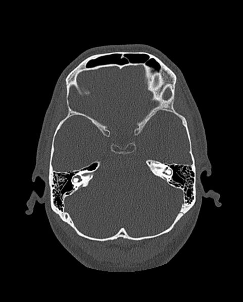 File:Chronic maxillary sinusitis caused by a foreign body (Radiopaedia 58521-65676 Axial bone window 264).jpg