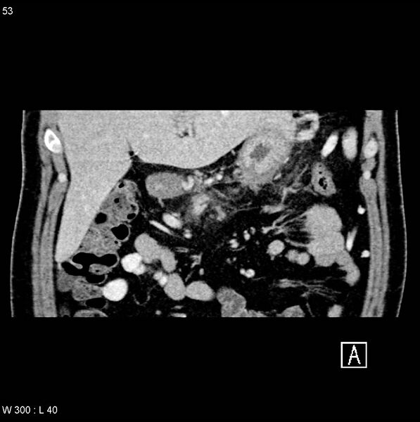 File:Chronic pancreatitis and pseudocysts (Radiopaedia 6724-7935 C 1).jpg