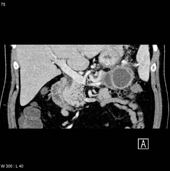 File:Chronic pancreatitis and pseudocysts (Radiopaedia 6724-7935 C 7).jpg