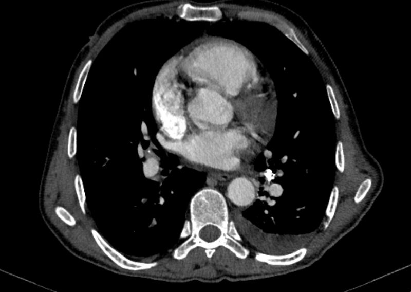 File:Chronic pulmonary embolism with bubbly consolidation (Radiopaedia 91248-108850 C+ arterial phase 85).jpg
