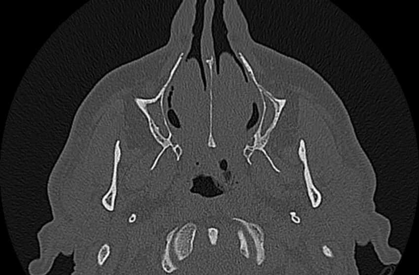 Chronic rhinosinusitis (Radiopaedia 65079-74075 Axial bone window 15).jpg