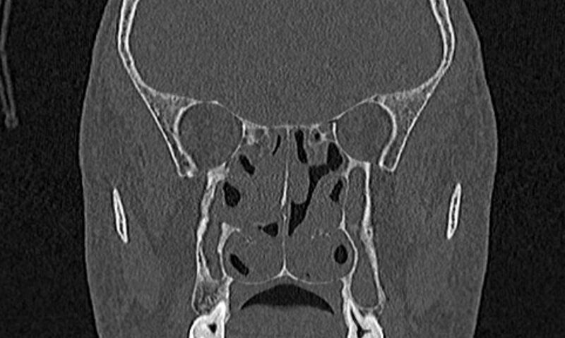 File:Chronic rhinosinusitis (Radiopaedia 65079-74075 Coronal bone window 49).jpg