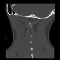 Clay-shoveler fracture (Radiopaedia 22568-22590 Coronal bone window 37).jpg