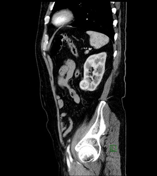 File:Clear cell renal cell carcinoma (Radiopaedia 85006-100539 E 14).jpg