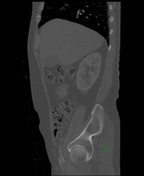 File:Clear cell renal cell carcinoma (Radiopaedia 85006-100539 Sagittal bone window 45).jpg
