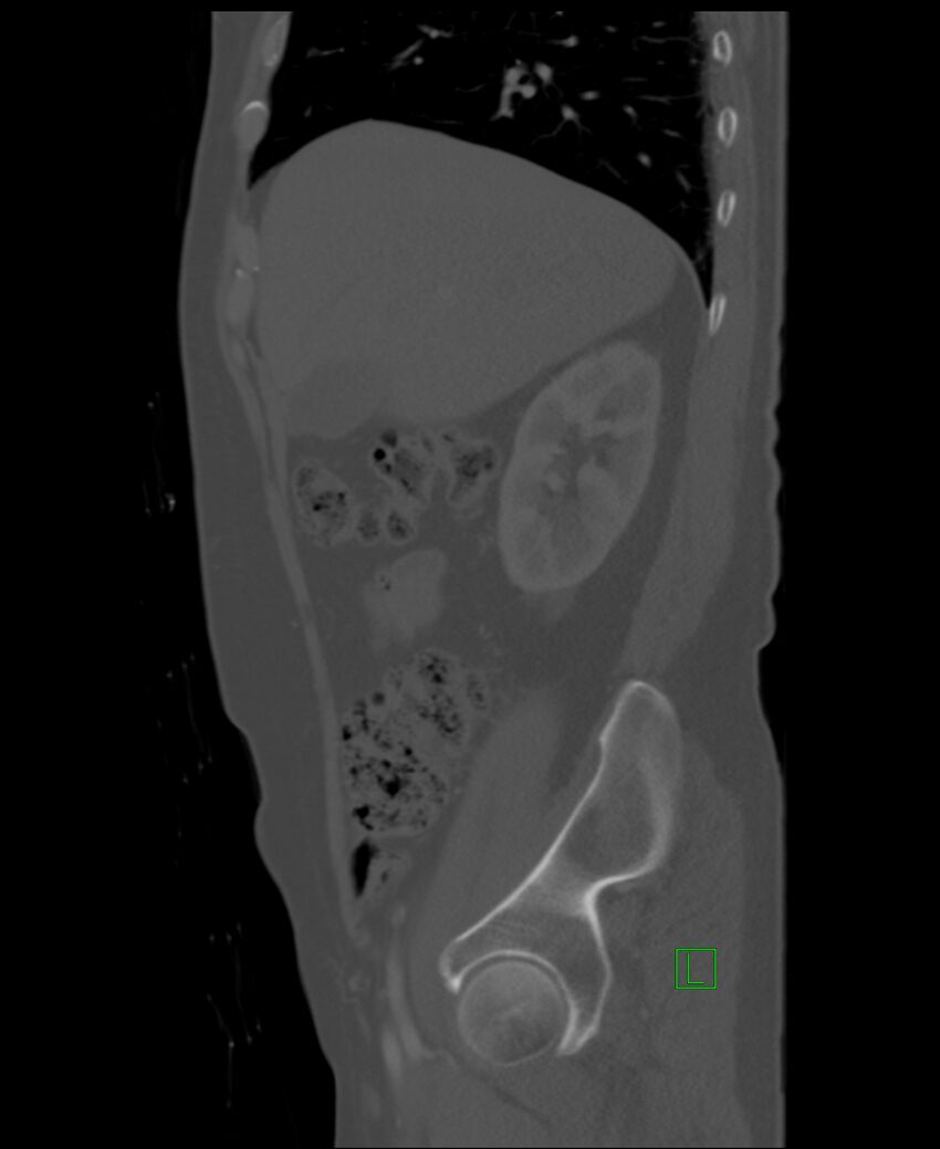 Clear cell renal cell carcinoma (Radiopaedia 85006-100539 Sagittal bone window 45).jpg