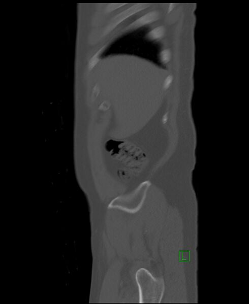 File:Clear cell renal cell carcinoma (Radiopaedia 85006-100539 Sagittal bone window 55).jpg