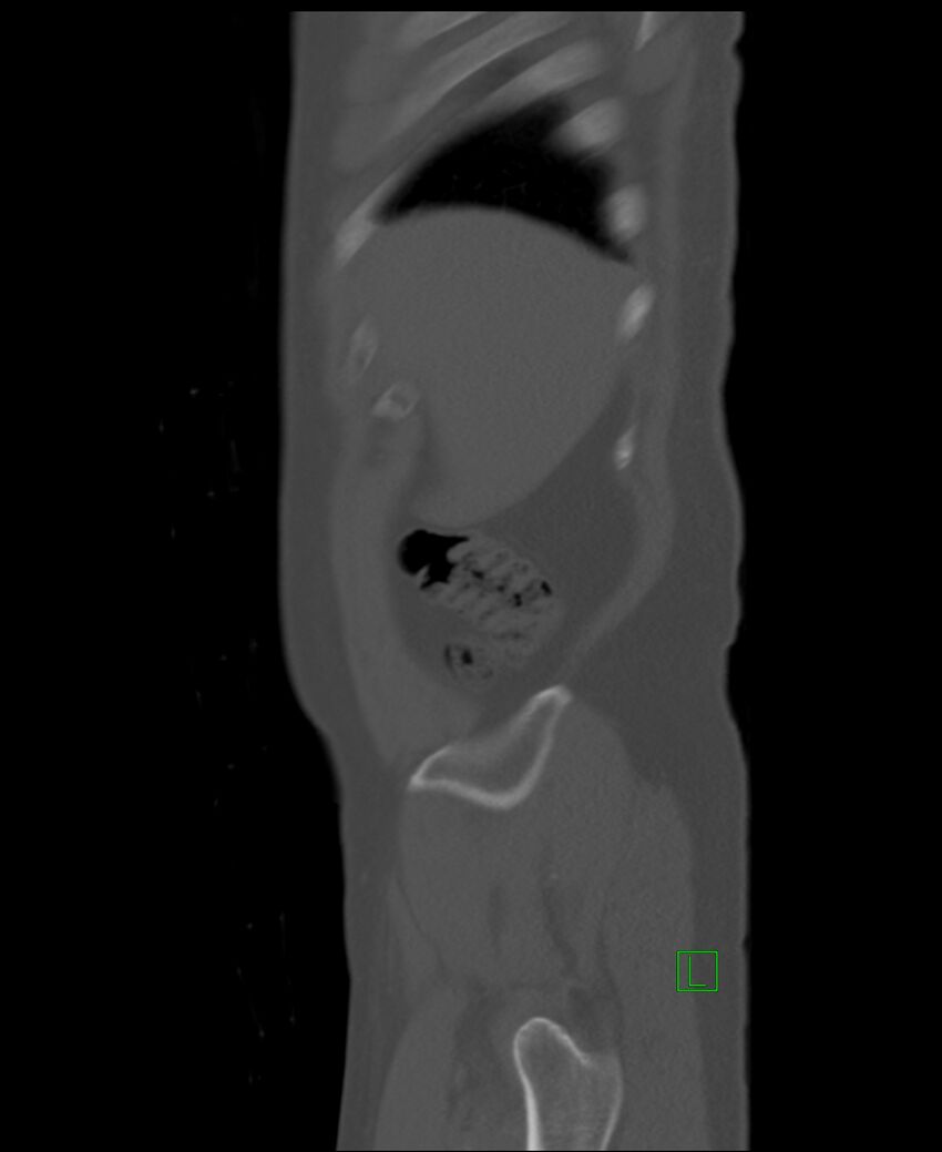 Clear cell renal cell carcinoma (Radiopaedia 85006-100539 Sagittal bone window 55).jpg