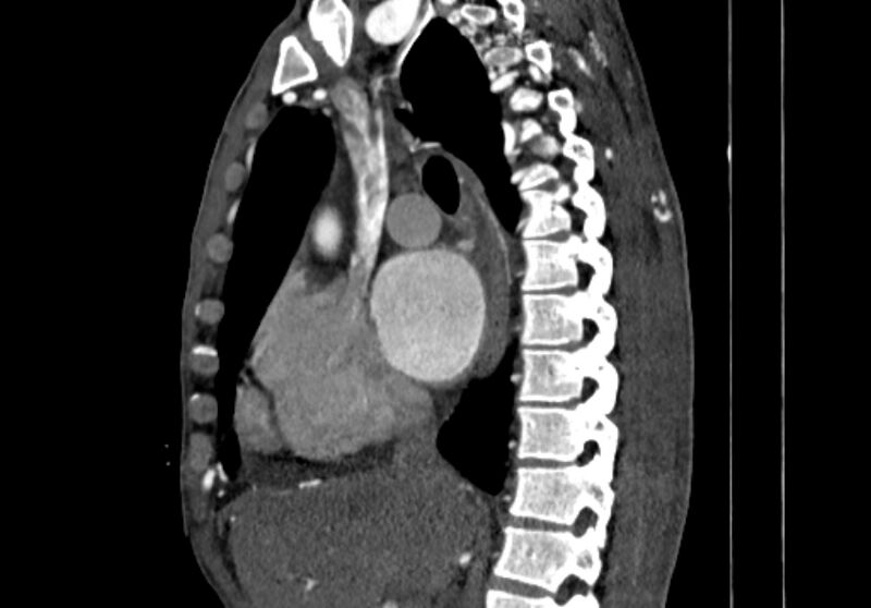 File:Coarctation of aorta with aortic valve stenosis (Radiopaedia 70463-80574 B 32).jpg