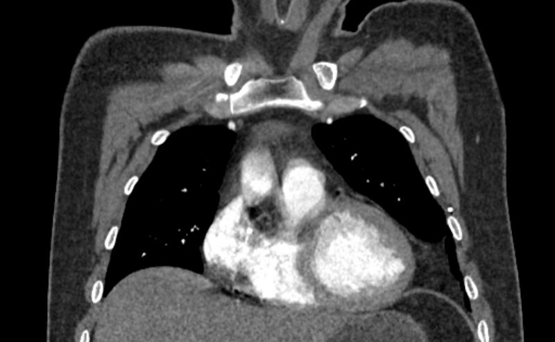 File:Coarctation of the aorta (Radiopaedia 53363-59343 C 18).jpg