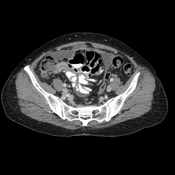 File:Cocoon abdomen with possible tubo-ovarian abscess (Radiopaedia 46235-50636 A 35).png