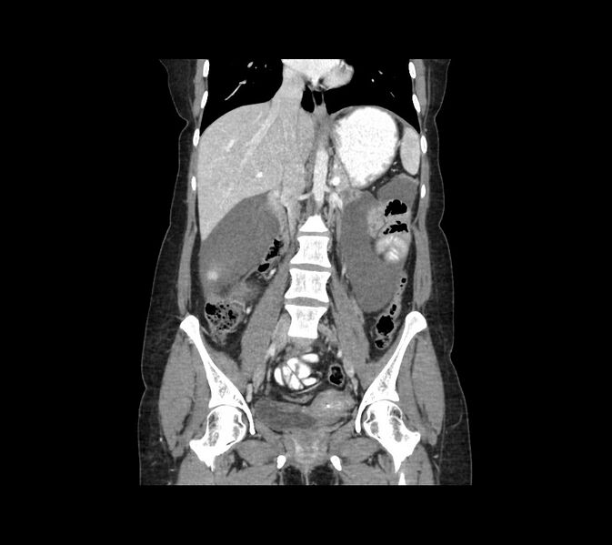 File:Cocoon abdomen with possible tubo-ovarian abscess (Radiopaedia 46235-50636 B 29).jpg