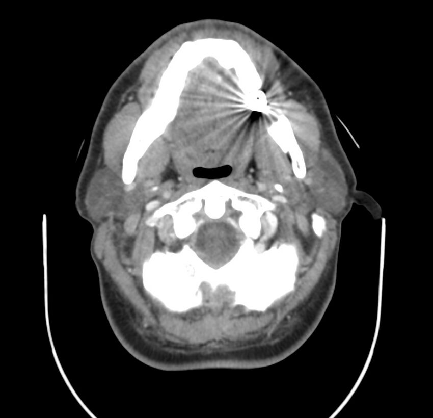 Colloid cyst of thyroid (Radiopaedia 22897-22923 Axial C+ delayed 22).jpg