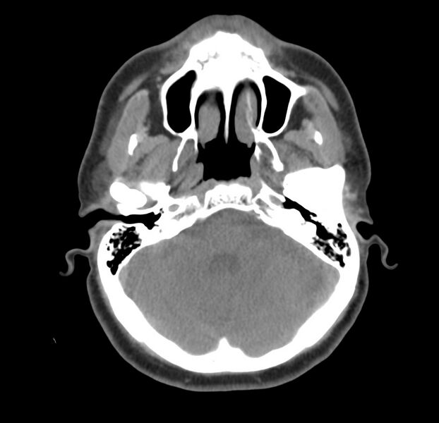 File:Colloid cyst of thyroid (Radiopaedia 22897-22923 Axial non-contrast 5).jpg