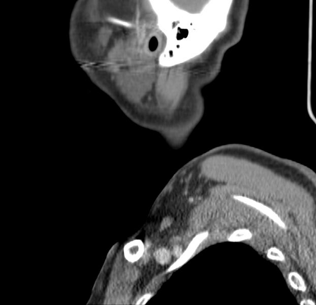 File:Colloid cyst of thyroid (Radiopaedia 22897-22923 Sagittal C+ delayed 53).jpg