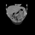 Colocolic fistula - Crohn disease (Radiopaedia 57063-63955 B 8).jpg