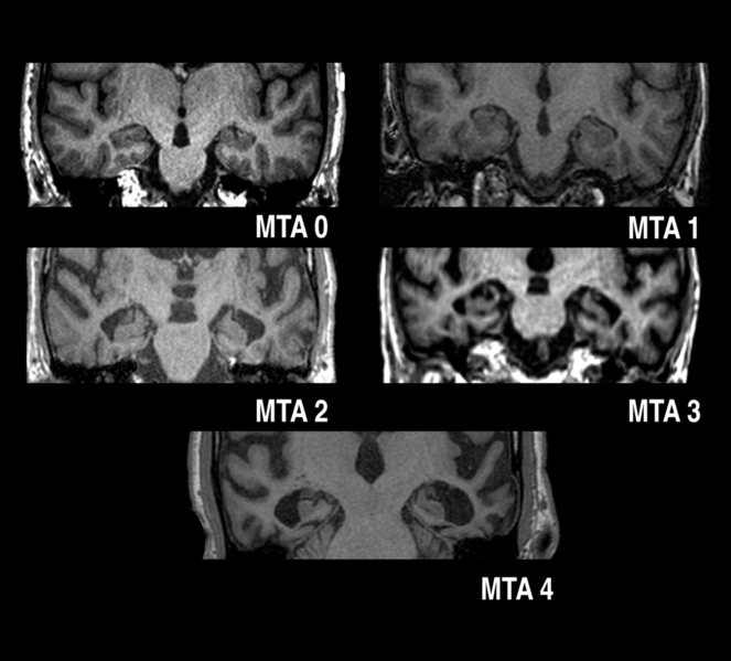 File:Medial temporal lobe atrophy score (Radiopaedia 42027).png
