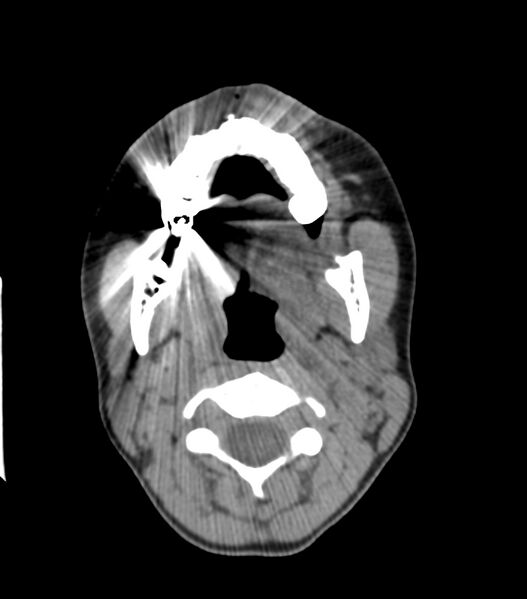 File:Nasoorbitoethmoid fracture (Radiopaedia 90044-107205 Axial non-contrast 85).jpg