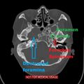Nasopharyngeal carcinoma recurrence - skull base destruction (Radiopaedia 29107-30461 C 1).jpg