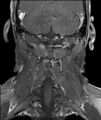 Neurofibromatosis type 1 (Radiopaedia 80355-93740 I 10).jpg