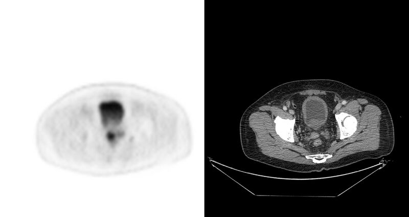 File:Non-Hodgkin lymphoma involving seminal vesicles with development of interstitial pneumonitis during Rituximab therapy (Radiopaedia 32703-33675 axial PET CT 10).jpg