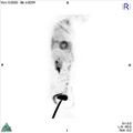 Non-Hodgkin lymphoma involving seminal vesicles with development of interstitial pneumonitis during Rituximab therapy (Radiopaedia 32703-33761 PET cor 3D MIP 10).jpg