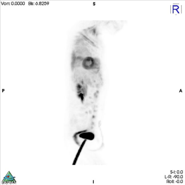 File:Non-Hodgkin lymphoma involving seminal vesicles with development of interstitial pneumonitis during Rituximab therapy (Radiopaedia 32703-33761 PET cor 3D MIP 10).jpg