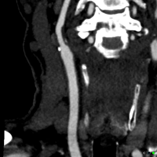 File:Non-occlusive intraluminal internal carotid artery thrombus (Radiopaedia 37751-39658 C 36).jpg