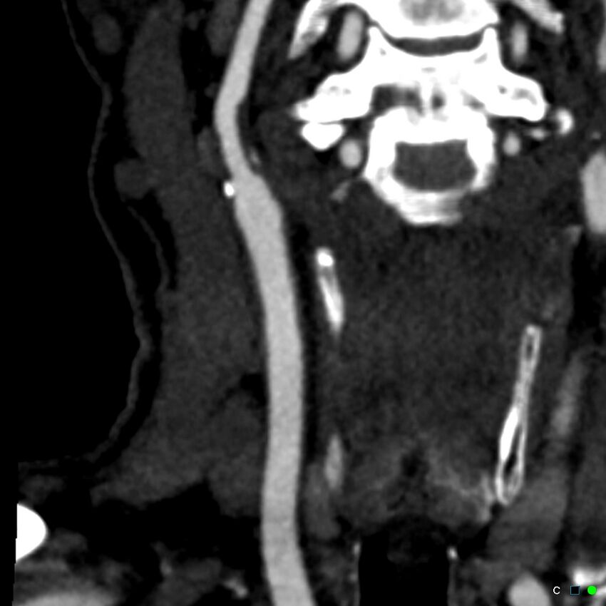 Non-occlusive intraluminal internal carotid artery thrombus (Radiopaedia 37751-39658 C 36).jpg