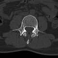 Normal CT lumbar spine (Radiopaedia 53981-60118 Axial bone window 44).jpg
