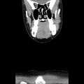Normal CT of the neck (Radiopaedia 14575-14500 Coronal C+ 15).jpg