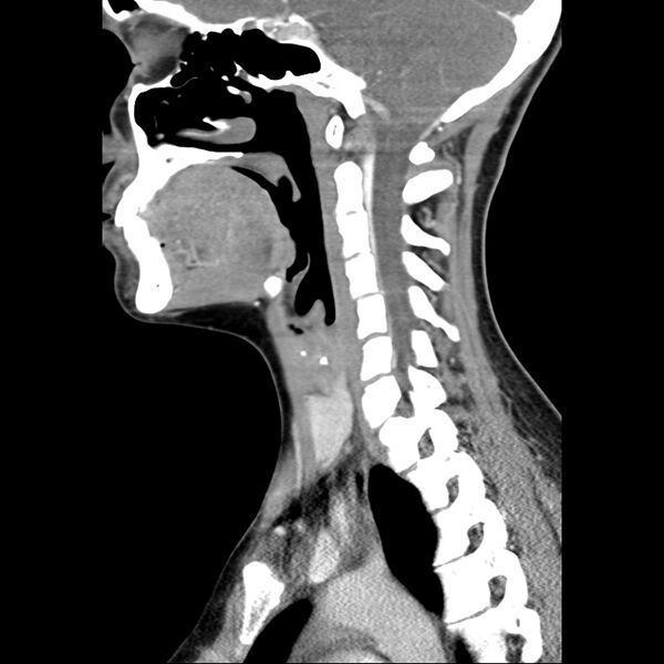 File:Normal CT of the neck (Radiopaedia 14575-14500 Sagittal C+ 24).jpg