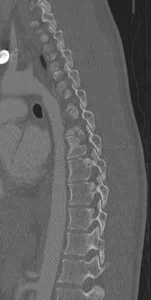 File:Normal CT thoracic spine (Radiopaedia 40181-42688 Sagittal bone window 25).png