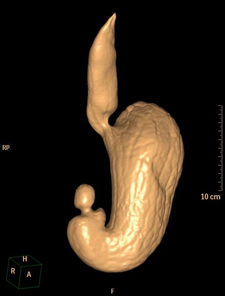File:Normal CT virtual gastroscopy (Radiopaedia 29960-30501 3D VG 11).jpg