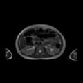 Normal MRI abdomen in pregnancy (Radiopaedia 88001-104541 Axial T2 25).jpg
