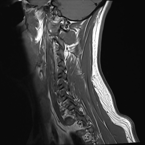 File:Normal MRI cervical spine (infection protocol) (Radiopaedia 53916-60039 Sagittal T1 2).png
