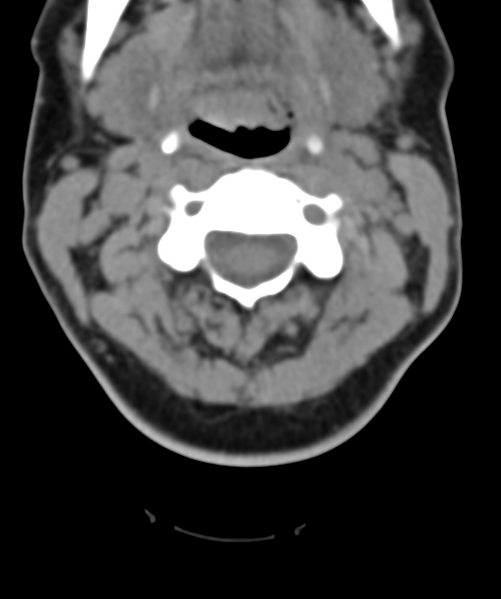 File:Normal cervical spine MRI (including Dixon) (Radiopaedia 42762-45926 Axial non-contrast 22).png