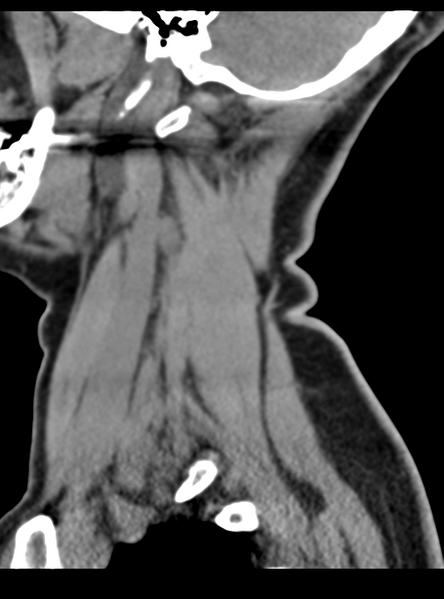 File:Normal cervical spine MRI (including Dixon) (Radiopaedia 42762-45926 C 9).png