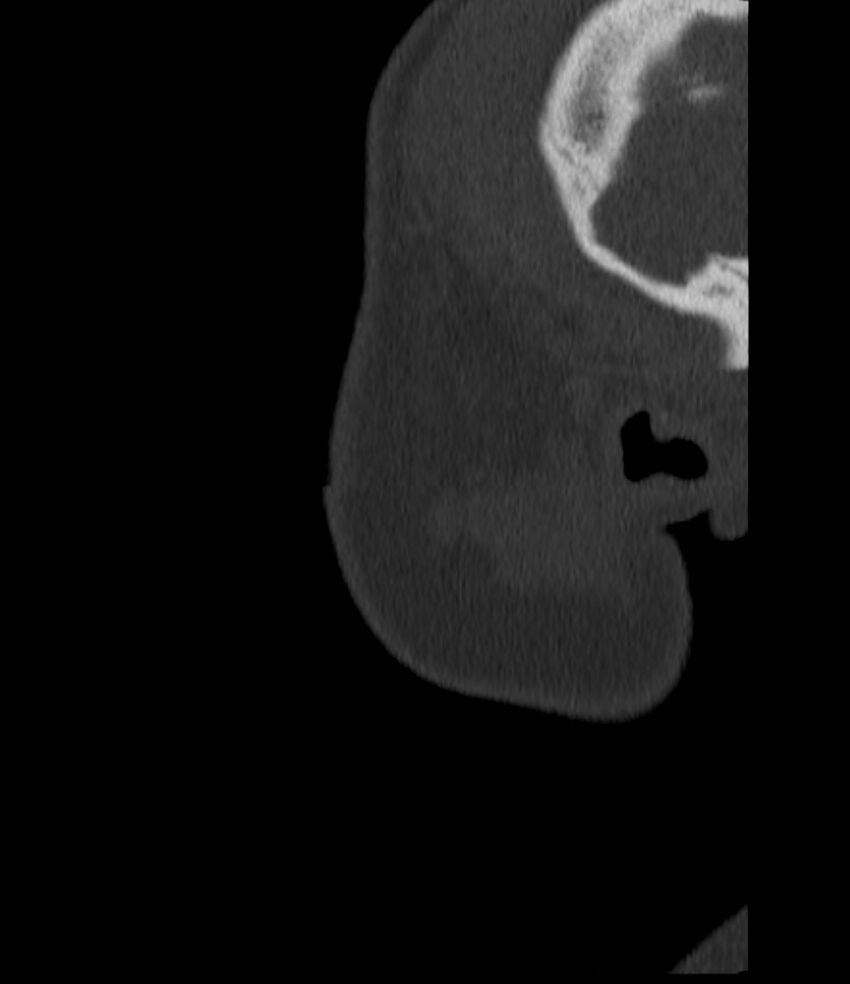 Normal facial bone CT (Radiopaedia 88742-105476 Sagittal bone window 17).jpg